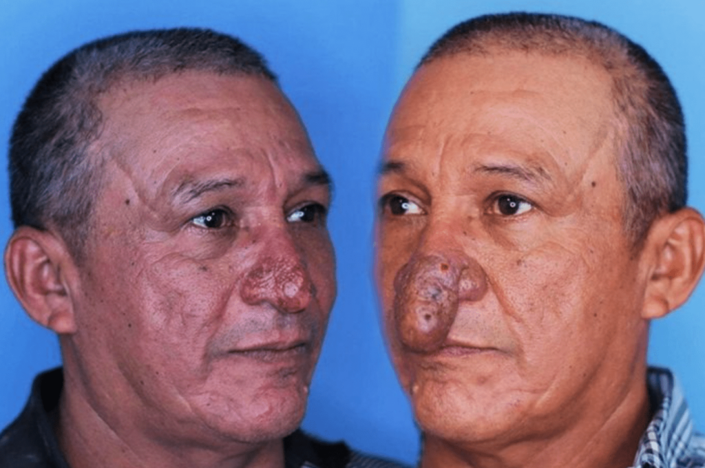 The Remarkable Transformation of Conrado’s Nose